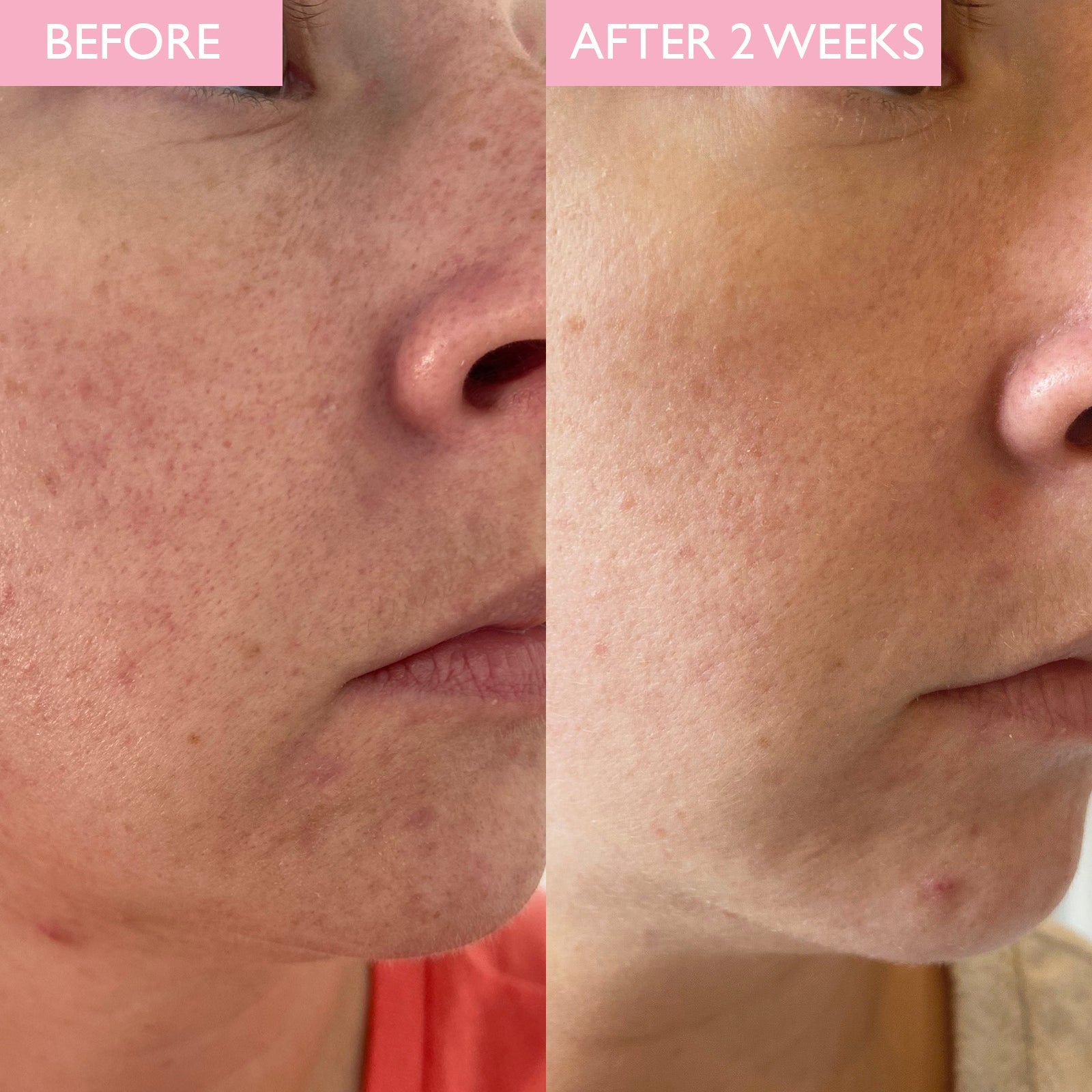 Before and After image of skin improvements