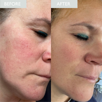Before and after comparison of a woman's face with visible skin improvement.