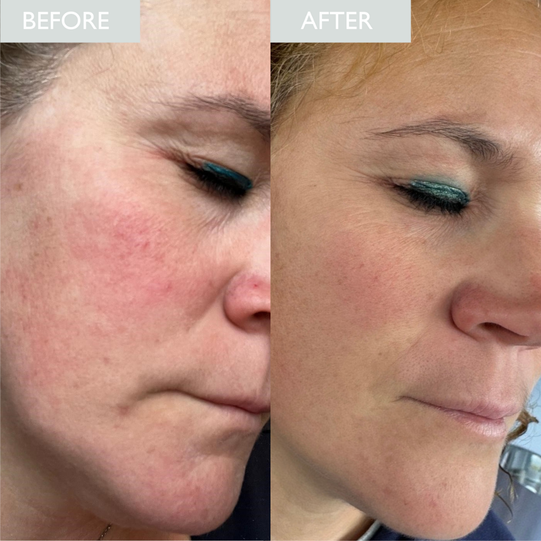 Before and after comparison of a woman's face with visible skin improvement.