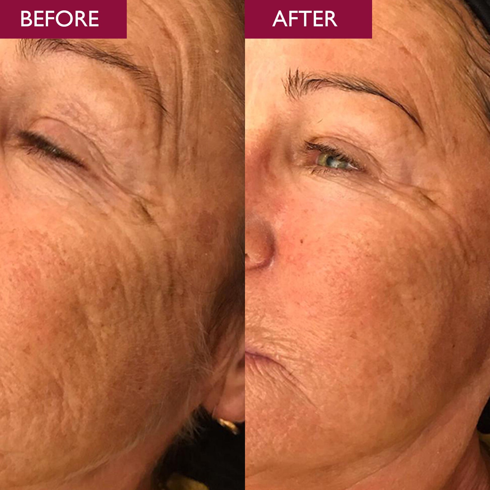 Before and after comparison of a person's eye area with visible reduction in wrinkle depth