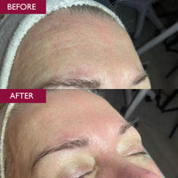Before and after comparison of a person's forehead with visible reduction in wrinkle depth