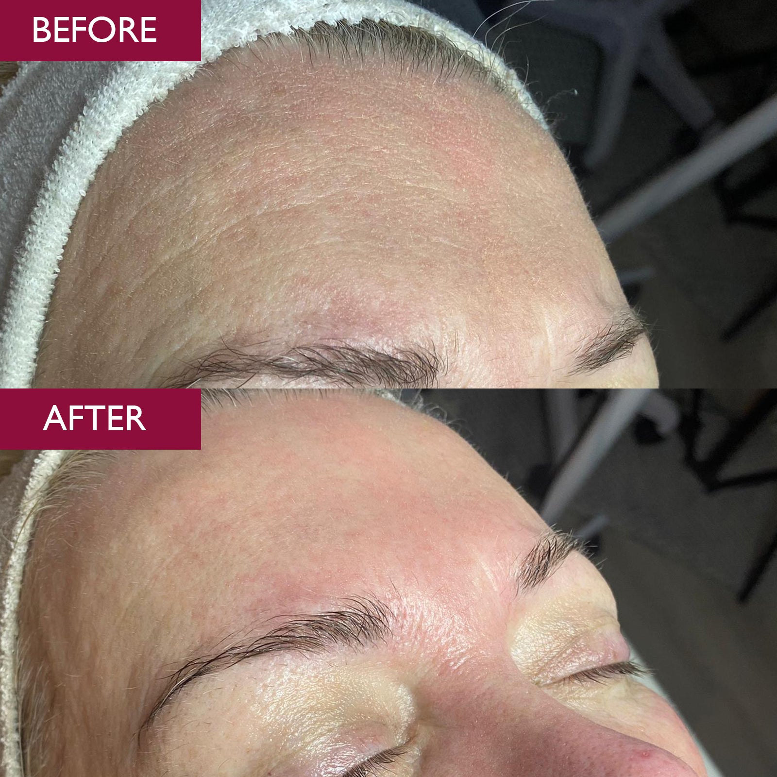 Before and after comparison of a person's forehead with visible reduction in wrinkle depth