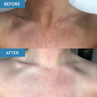 Before and after comparison of woman's shoulder area. The before image shows patchy tan and the after shows the patchy tan removed to reveal smooth skin