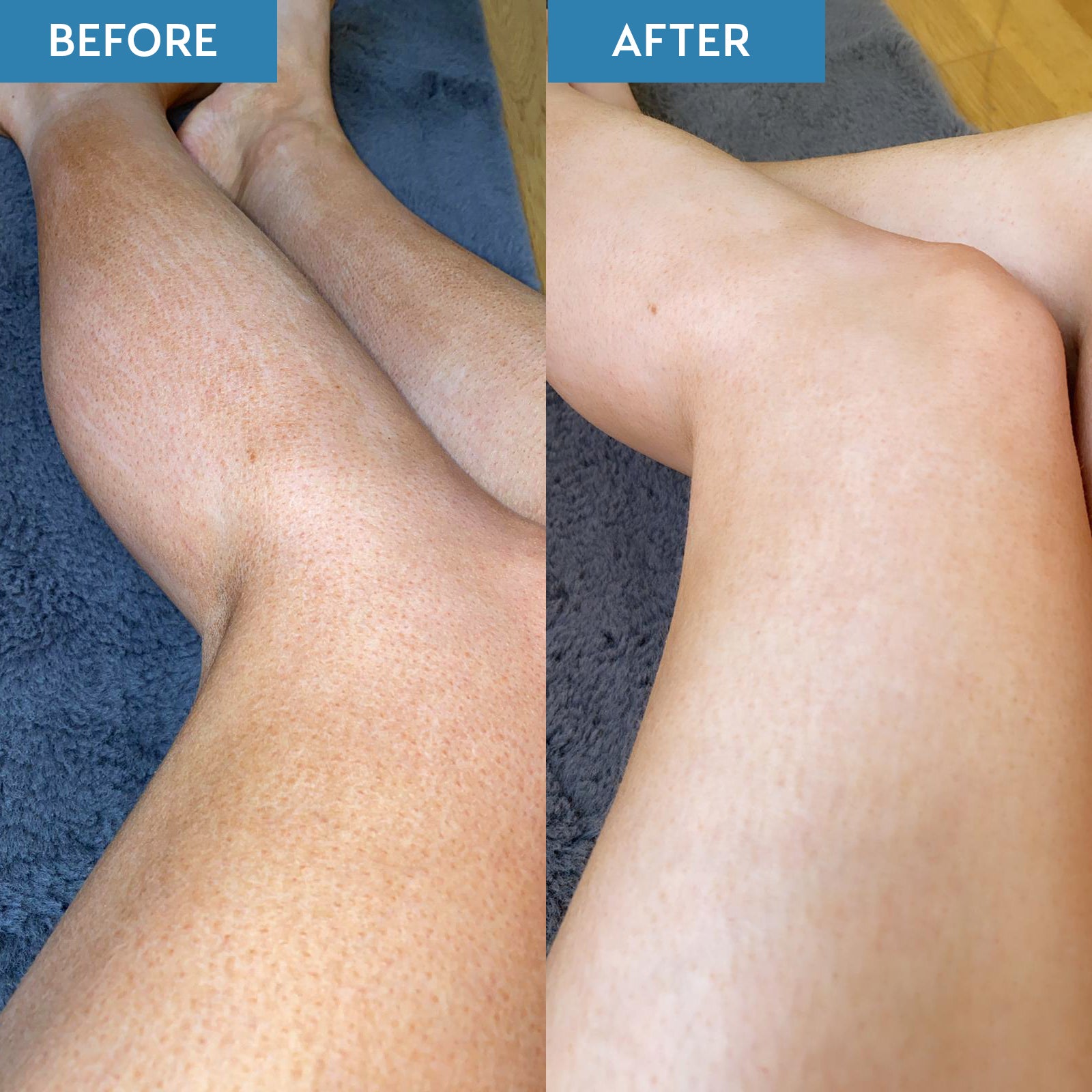 Before and after comparison of legs. The before image shows patchy tan and the after shows the patchy tan removed to reveal smooth skin