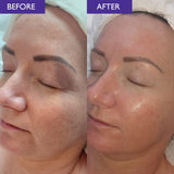 Before and after comparison of a woman's face with visible skin improvement.