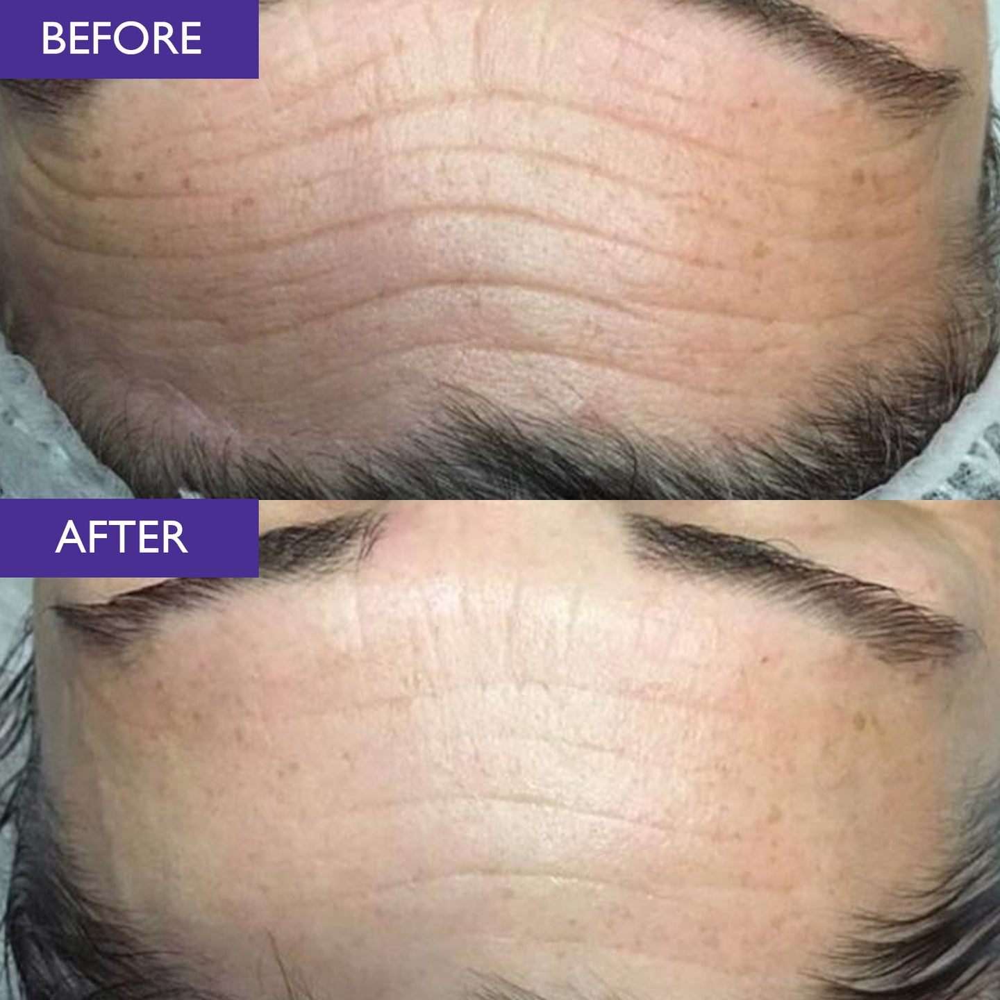 Before and after comparison of a person's forehead with visible wrinkles reduced