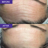 Before and after comparison of a person's forehead with visible wrinkles reduced
