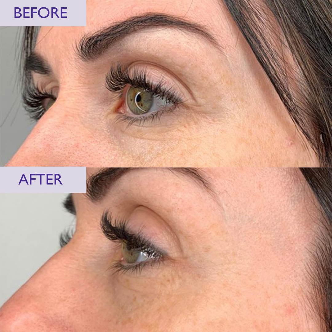Before and after comparison of eye area treatment showing visible improvement in crows feet