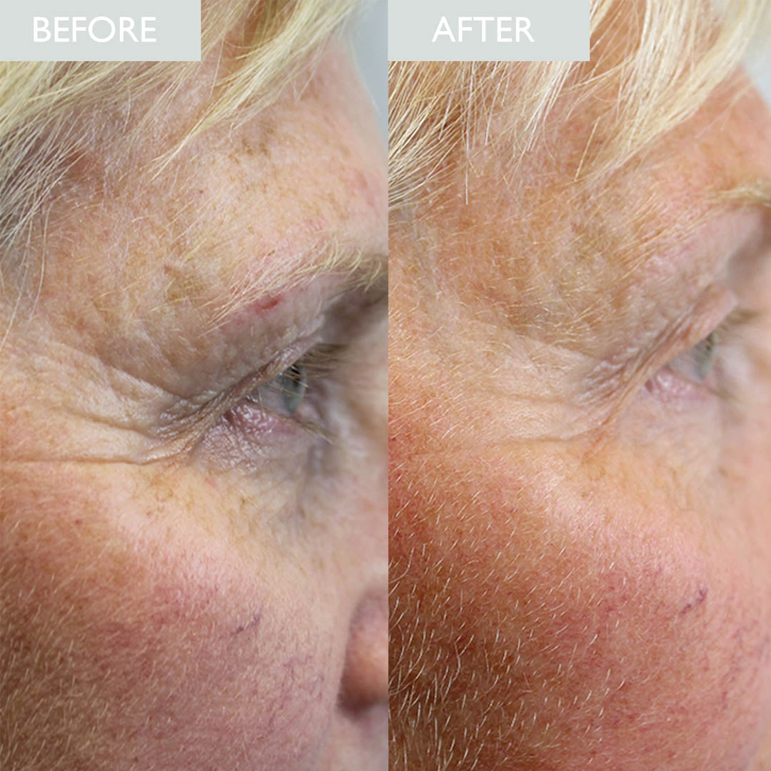 Before and after comparison of eye area showing a visible reduction in crows feet depth