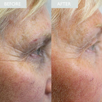 Before and after comparison of eye area showing a visible reduction in crows feet depth