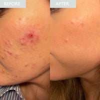 Before and after comparison of acne on a person's face.