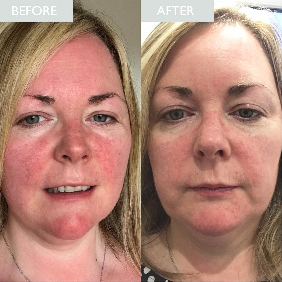 Before and after comparison of a woman's face with visible improvement in redness