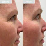 Before and after comparison of a person's face with visible reduction in wrinkle depth shown.