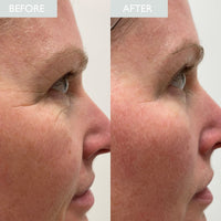 Before and after comparison of a person's face with visible reduction in wrinkle depth shown.