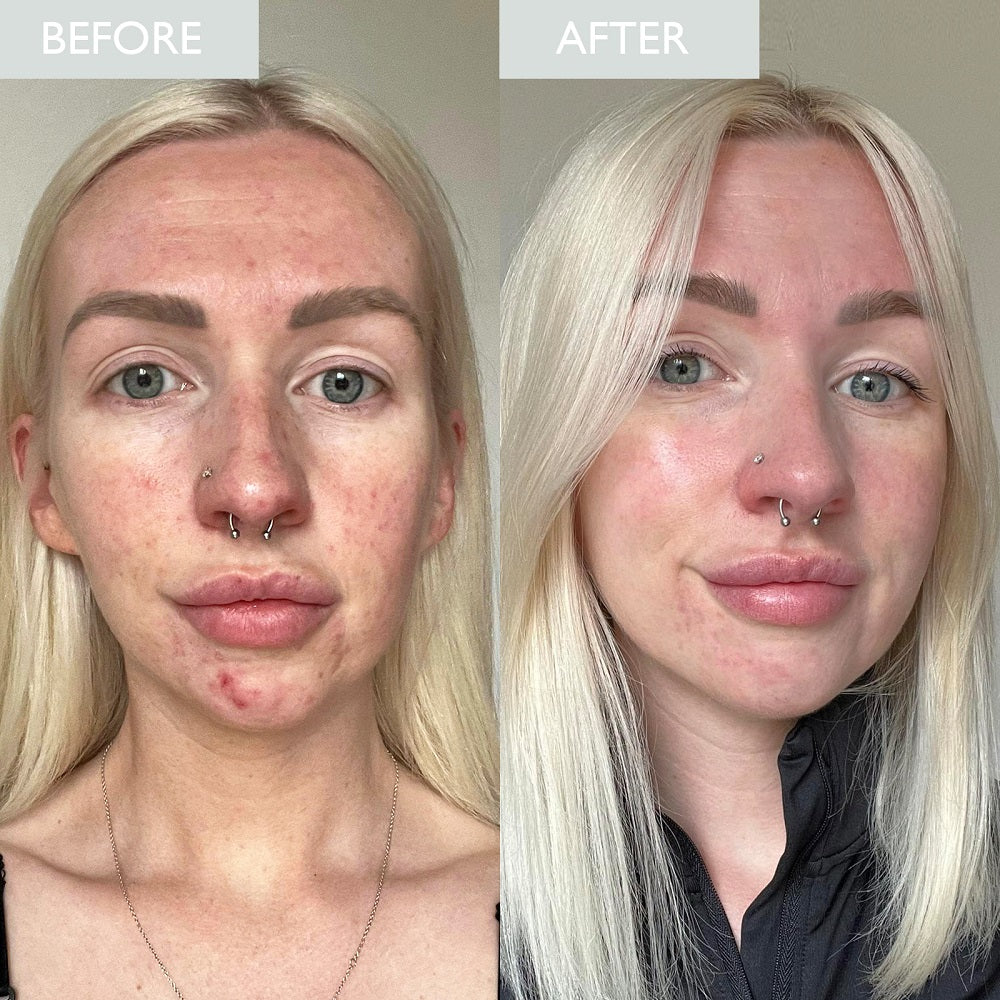 Before and after comparison of a woman's skin demonstrating an improvement in skin breakouts 