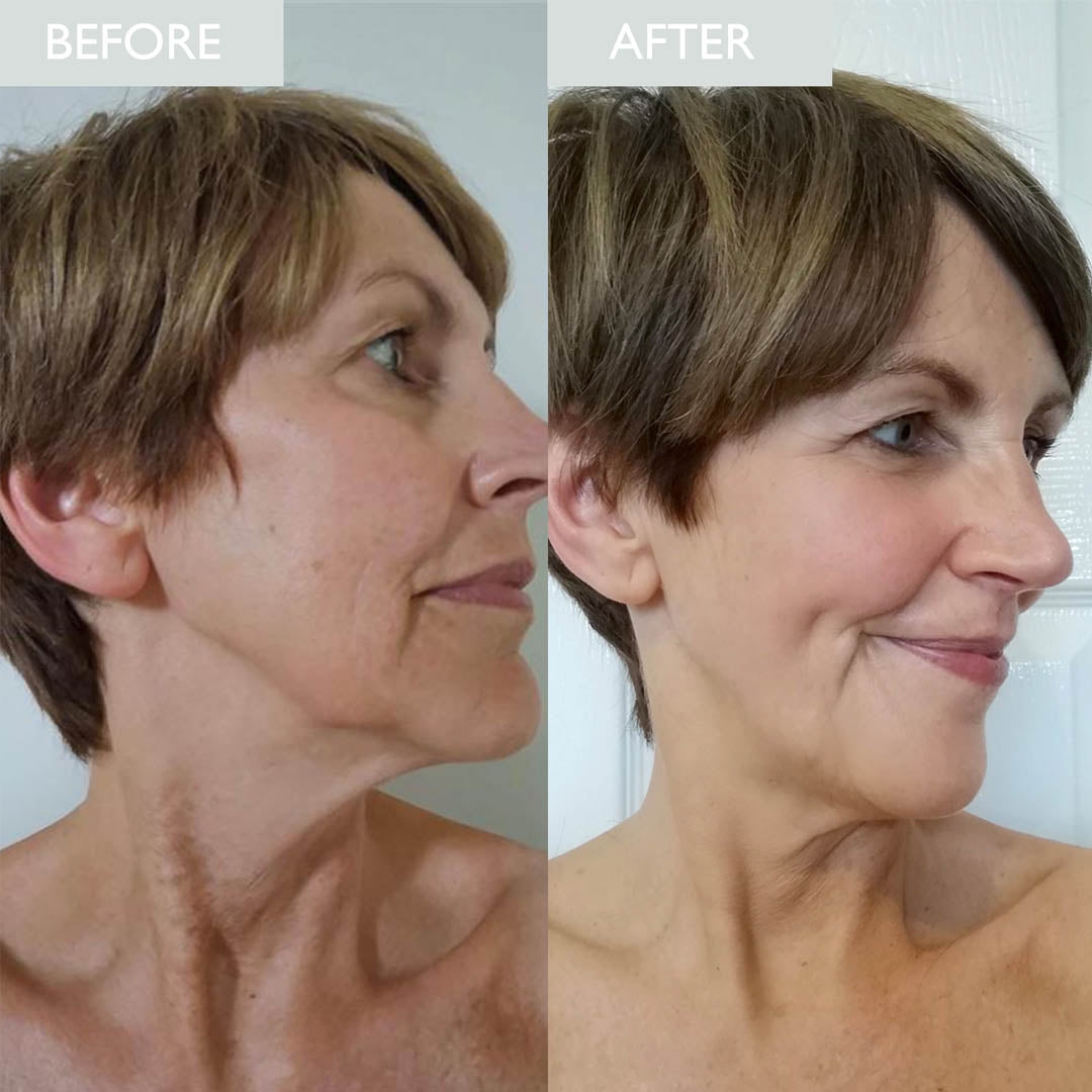 before and after of a woman with noticeable ageing improvements.