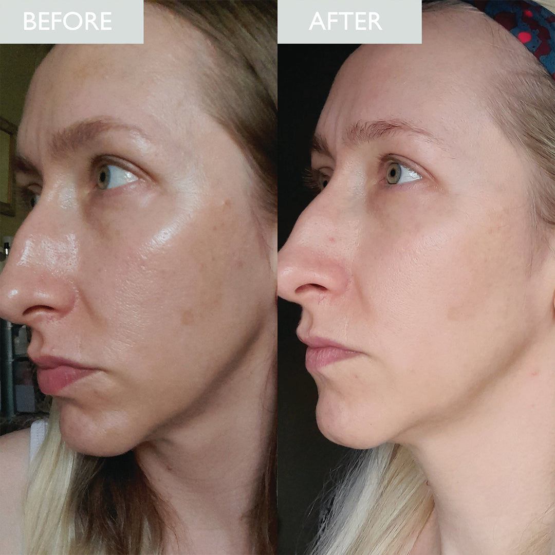 before and after image of a lady who has oily skin before using the product and an improvement of less oil shown on her skin after using the SPF moisturizer