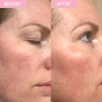Before and after comparison of a woman's face with visible skin texture differences.