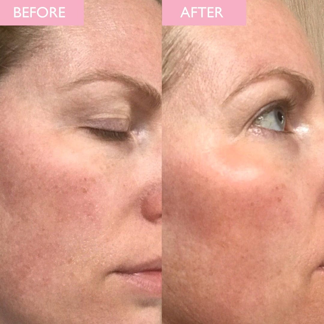 Before and after comparison of a woman's face with visible skin texture differences.