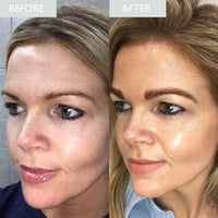Before and after image of woman showing improvement in skin glow and reduction in wrinkle depth
