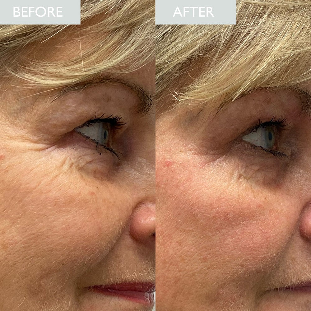 Before and after comparison of a woman's eye area with visible skin improvement.
